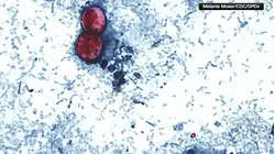 The Cyclospora parasite is lurking in your produce. Here's how to avoid it