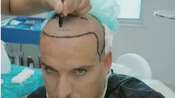 Serial Lip Filler