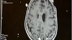 New dementia study released