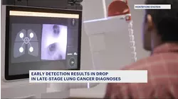 Early detection of lung cancer results in decline in diagnoses