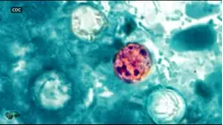 Health alert about cyclosporiasis parasitic infection